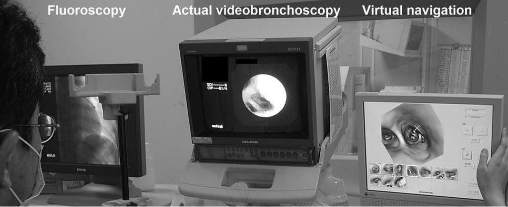 bronkoskopik görüntü eş-zamanlı,