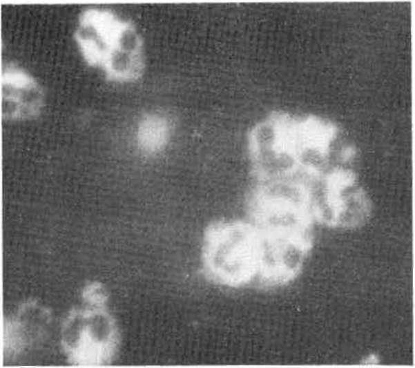 Perinükleer boyanma örneği gösteren antinötrofil sitoplazmik antikorlar (P-ANCA)'m indirekt immün floresans mikroskopik görünümü da, başka granül elemanlarına karşı reaksiyon veren CANCA ve P-ANCA da