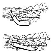 Eklem sadece alt molarlara vidayla bağlanmakta, apareyin üst kısmı, üst molar kronu veya bandındaki kanca