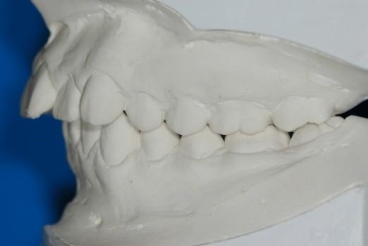 1. Hastanın koltukta dik pozisyonunda aljinat ölçü maddesiyle alt ve üst çene ölçüleri ve dişler normal oklüzyondayken mumlu kapanışı alındı.