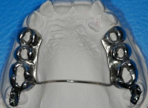 Alt çenedeki lingual ark, destek dişlerinin gömülmesi ve bukkal e devrilmesini engellemektedir.