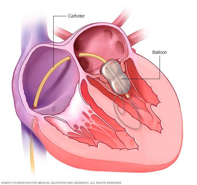 Mitral kapak darlığında uygulanan balon valvuloplasti 2-Mitral Mandal Tedavisi(Mitral Kapak Klipleme):Özellikle açık ameliyat riski yüksek olan ilave hastalığı olanlar, kalp kasılmasında önemli