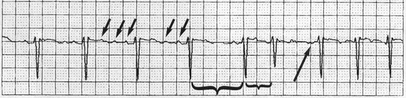 Atrial