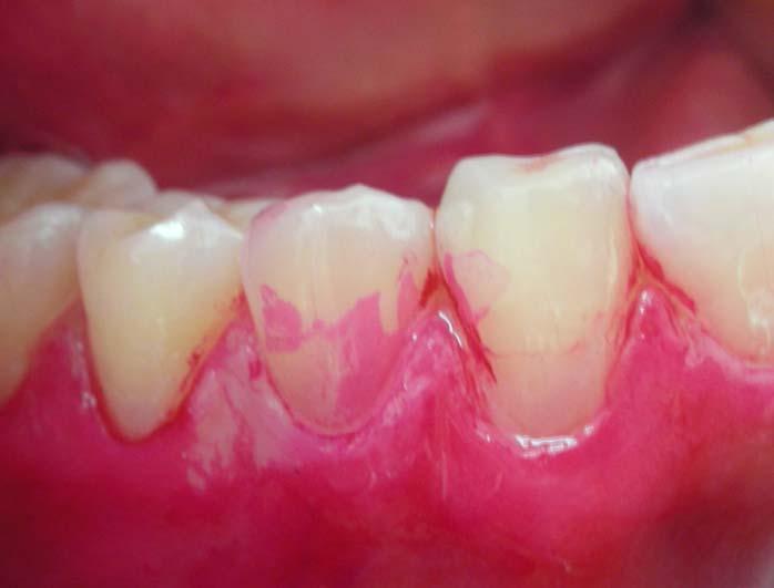 2.8.2. Plak Retansiyonunun Klinik Olarak Değerlendirilmesi Modifiye Quigley-Hein Plak İndeksi: Dişlerdeki mikrobiyal dental plak, %0.