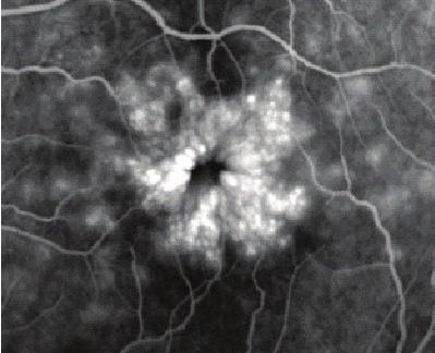 Ret-Vit Özel Sayı 2014;22:135-142 Öz 139 Çok az veya hiç diabetik retinopatisi olmayanlarla normal olgular arasında benzer prognoz görülmektedir.