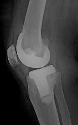 Osteofitlerin temizlenmesi Protezin gerçek boyutunun saptanması için önemli Medial