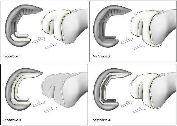 Vaninbroukx M: Cementing the femoral component in total knee