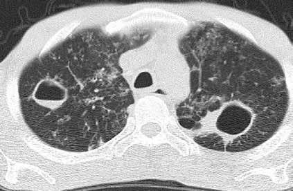 226 Salih Hamcan Kemal Kara Resim 10: Arkus aorta düzeyinden geçen BT kesitinde, her iki akciğer üst lobda kaviter lezyonlar ve bronkojenik yayılımın göstergesi milimetrik nodüler dansiteler