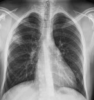 BÖLÜM 22 Akciğer Tüberkülozu Radyolojisi 219 Bağışıklık sistemi fonksiyonları normal olan bireylerde radyolojik bulgular, primer ve postprimer (reaktivasyon) hastalık başlıkları altında