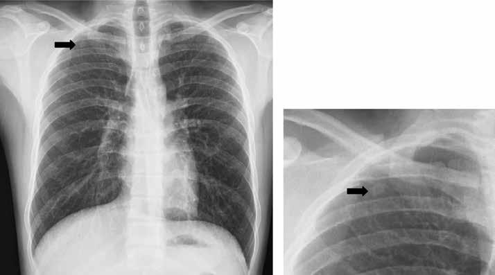 220 Salih Hamcan Kemal Kara alt loblar ve üst lobların anterior segmentleri olmaktadır (9). Sağ akciğer, tutulum açısından sola göre daha dominanttır.
