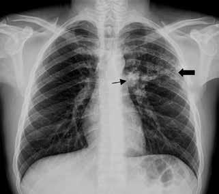 BÖLÜM 22 Akciğer Tüberkülozu Radyolojisi 221 Resim 3: PA akciğer grafisinde, sol akciğer üst zonda kalsifikasyon içeren skar ile iyileşmiş parankimal hastalık (kalın ok) ve sol hiler kalsifiye lenf