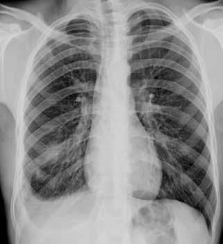 BÖLÜM 22 Akciğer Tüberkülozu Radyolojisi 223 Resim 6: PA akciğer grafisinde, sağ akciğer alt zonda belirsiz sınırlı konsolidasyon ve eşlik eden plevral efüzyon görülmektedir.