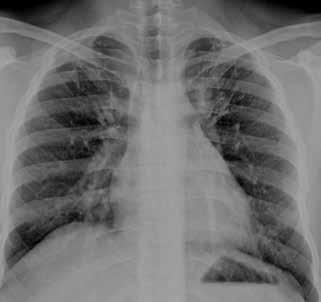 BÖLÜM 22 Akciğer Tüberkülozu Radyolojisi 225 Resim 8: PA akciğer grafisinde, her iki akciğer üst zonda nodüler opasiteler ve hilusa uzanım gösteren lineer dansiteler görülmektedir.