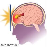 İç Kanamalarda Bölgesel Değişiklikler ve Belirtiler Kafa içi Kanamalar Baş ağrısı Fışkırır