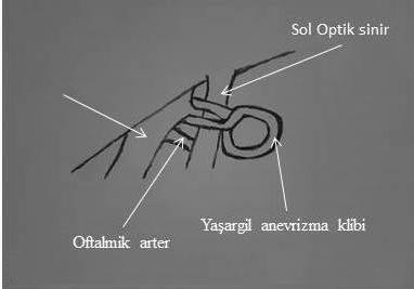 Genelde postero-medial yerleşimli olduğundan anevrizma tarafından daha mediale itilmiş yapılanmasında medial-sitriat arter ile karıştırılabilir.