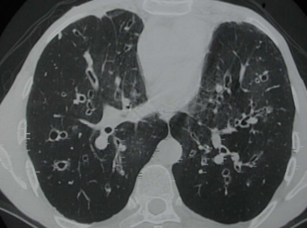 Normal pulmoner arter