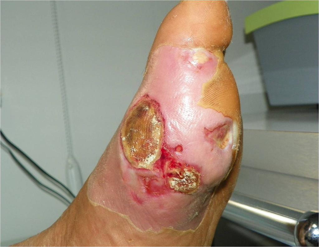 Şekil 4 Diyabete bağlı ayak yarası olan hastanın, a) tedavi öncesi b) tedavi sonrası görüntüleri.