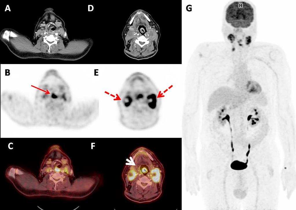 PET-BT görüntülerinde sağ supraglottik yerleşimli epiglota ve sağ bant ventriküle uzanım gösteren 3x2 cm boyutlarında kitlesel lezyonda yoğun artmış patolojik FDG tutulumu (kırmızı ok) (SUVmax:15.