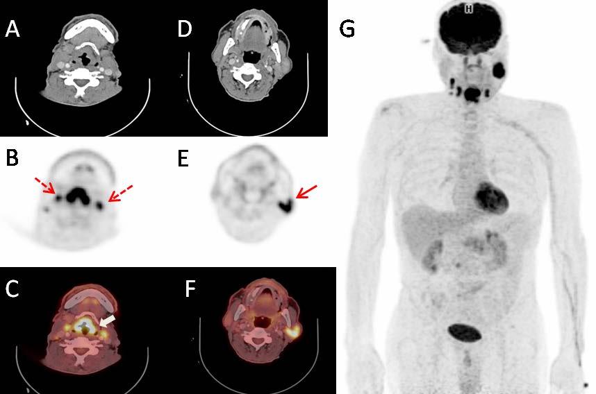 PET-BT görüntülerinde supraglottik larenkste epiglotta kalınlaşmaya yol açan lezyonda yoğun patolojik FDG tutulumu (kalın beyaz ok) (SUVmax:17.