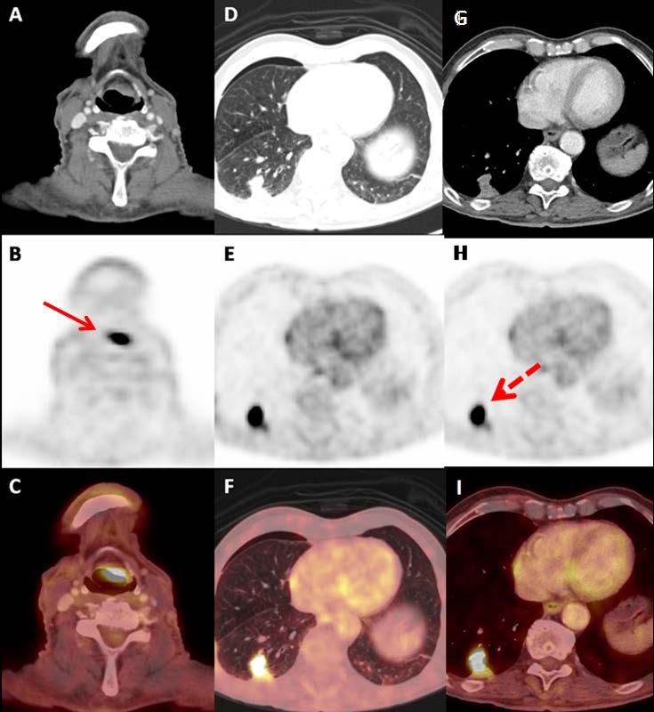 Epiglot sol kesimde yaklaşık 2.1x1.2 cm boyutlarında hava sütununu kısmen daraltan kitlesel lezyonda yoğun artmış patolojik FDG tutulumu (ok) (SUVmax:21.5) gösterilmiştir.