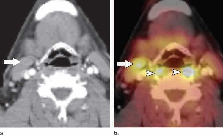 Asimetrik sternokleidomastoid ve