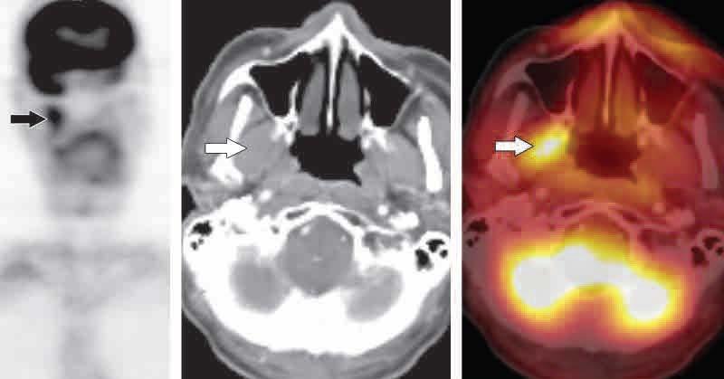 Sağ medial pterygoid kasta