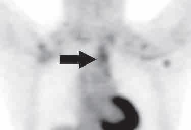 Antecubital ven enjeksiyonu sırasında ektravazasyona bağlı