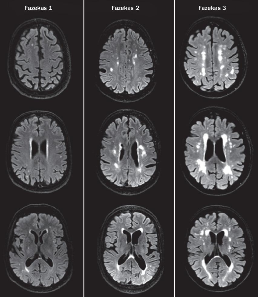 Alzheimer Hastalığı %43 mikroinfarktlar %33 sessiz enfarktlar