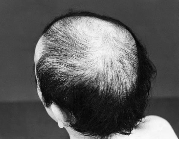 yaş, CADASIL-> ort 45, binswanger- >ort 55 yaş) Laküner stroke atakları Kognitif yıkım Alopesi ( ort.