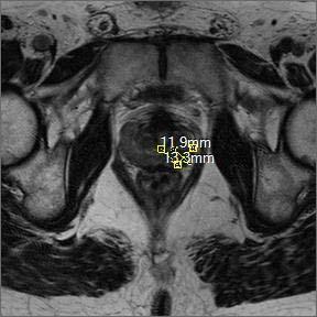 Prostat apeksi sol yarısından başlayarak periferik zon sol lateraline uzanan 11x13x13mm boyutlarında T2A serilerde hipointens silik konturlu lezyon mevcuttur.