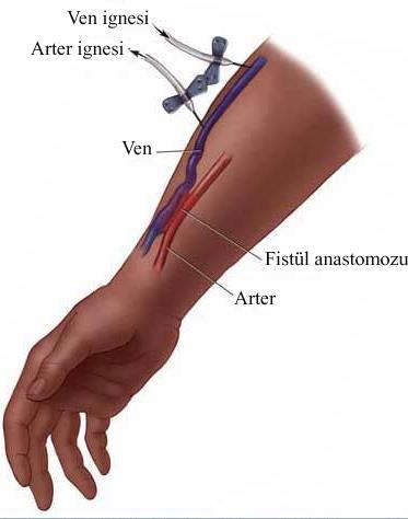 HEMODİALİZ VASKÜLER ERİŞİM