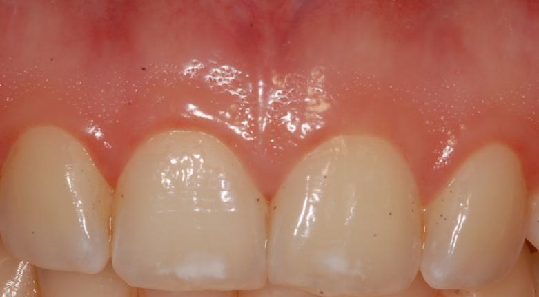 5 2. GENEL BİLGİLER 2.1. Periodonsiyum ve Diş Eti Periodonsiyum, diş eti, periodontal ligament, sement ve alveolar kemikten oluşan diş destek dokularının meydana getirdiği kompleks bir yapıdır.