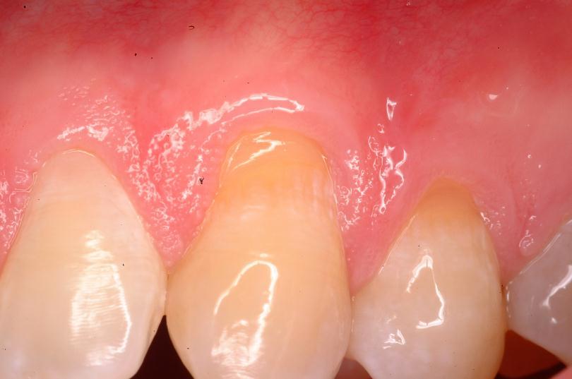 9 Günümüzde de yaygın olarak kullanılan Miller in sınıflamasına göre diş eti çekilmesi 4 sınıfa ayrılmıştır: Sınıf I: Marjinal doku