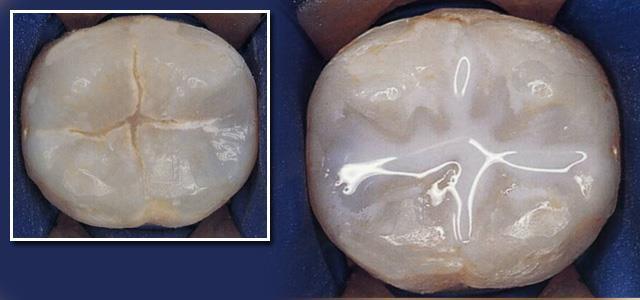 Diş Çürüğünden Korunma Yöntemleri Fissür Örtücü Uygulaması Koruyucu bir diş hekimliği uygulamasıdır.
