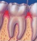 yetişkinlerde diş kaybının en önemli nedenlerinden biridir!