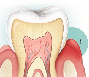 Dişeti Hastalıklarının Belirtileri Dişetinde ödem, kanama, kırmızılık, hiperemi dişeti iltihabının (gingivitisin)