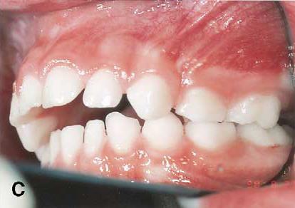 Diş Dizilimi Bozukluklarının Nedenleri Ağızdan Solunum Parmak Emme Dudak Emme Dille Dişleri İtme Tırnak Yeme Kalem ve benzeri şeyler Isırma Diş Gıcırdatma Anne