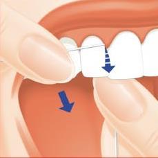 Diş ipini dişler arasına yerleştirin, diş yüzeyine yaslayarak, iki diş arasında bulunan üçgen formundaki dişeti papilinin 1-2 mm