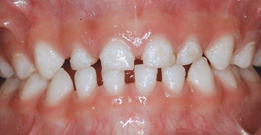 Dişlerin Fonksiyonu Fonksiyon (Isırma, koparma,çiğneme) Dişler besinlerin