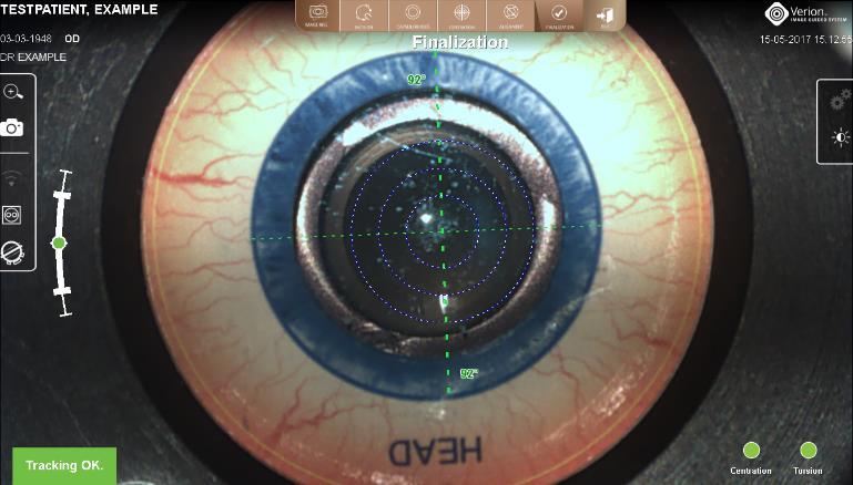 OVERLAY MODLARI Capsulorhexis (Kapsüloreksis) adımında aşağıdakiler Planlı kapsüloreksis boyutu ve pozisyonu.