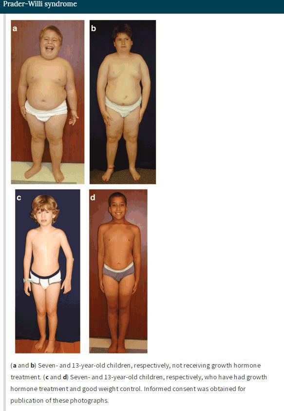 Prader Willi Syndrome: genetics, metabolomics, hormonal function, and new approaches to thera Prader Willi Syndrome: