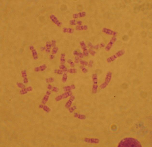 t(9) t(22) 22 9 Şekil 7: t(9;22) gösteren KML vakasından metafaz örneği (vaka 30)