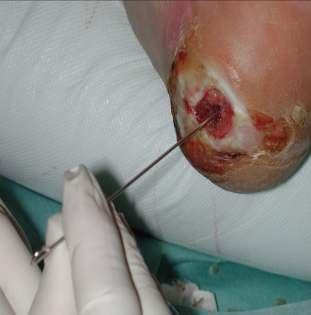 Enfekte ayak ülseri varlığında kemiğin palpe edilmesi osteomiyelitin güçlü kanıtı