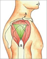 Deltoid Bölge Üst kol, dış yan kısımdaki küçük bir kas olan deltoid kasa da im enjeksiyon yapılabilir.