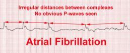 S u p rave ntriküle r A r itmile r (Sin ü s B ra d ika rd is i ) Kalp hızı 60 ın altındadır. Her P yi QRS izler. P dalgası D2 derivasyonunda pozitiftir.