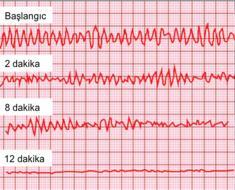 Ve ntriküle r A r itmile r (Ve ntriküle r F ib r ilasyo n ) = (VF) VF (Ventriküler Fibrilasyon) bütün kalp aritmilerinin en ciddisidir. Sonlandırılmadığı takdirde hızla mortal sonuçlara neden olur.