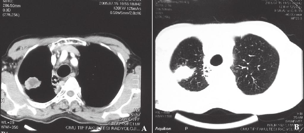 Kür sağlanan küçük hücreli akciğer karsinomlu olguda gelişen metakron akciğer kanseri (a) (b) Şekil 2.