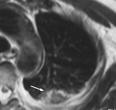 MR Imaging of pnemonia in