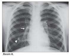 Akciğer Tüberkülozu 1.Primer tüberkülozda genellikle semptom yoktur. 2.