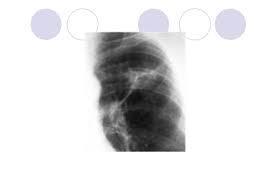 Tanıda akciğer radyolojisinin yeri: Primer tüberkülozda en tipik